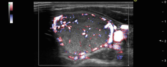 nodulo_tiroide_tir3_endocrinologiaoggi_roma