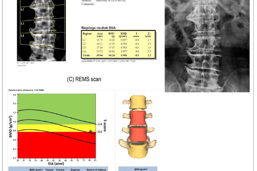 Densitometria ossea REMS senza radiazioni