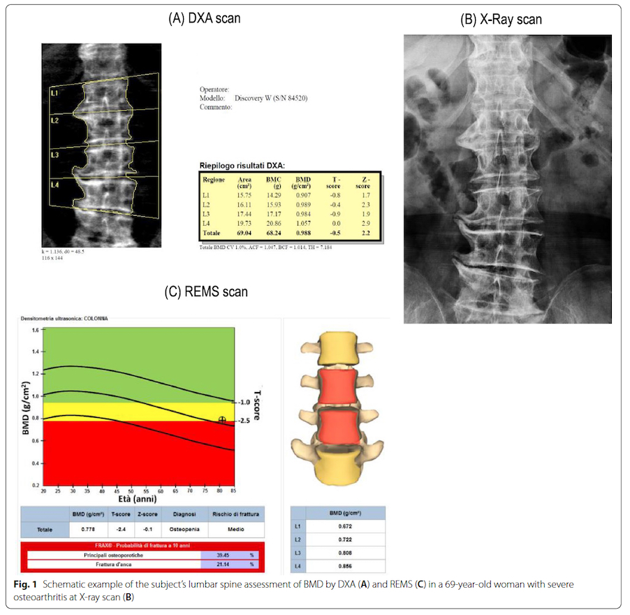 Densitometria ossea REMS senza radiazioni